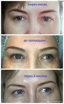 REGEN LAB PRP-терапия, усовершенствованная плазмотерапия - ЦИДК
