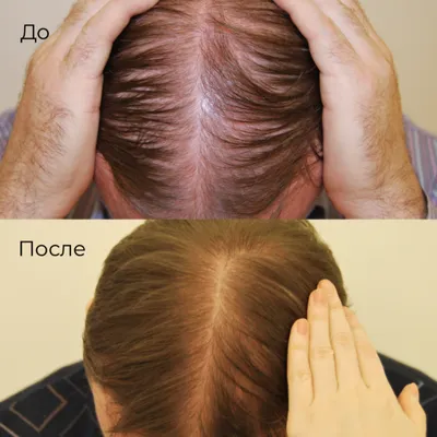 RTH (Real Trans Hair) - Результат после 4 процедур НеТЛАП-терапии в клинике  Real Trans Hair! НеТЛАП (Неактивированная тромбоцитарно-лейкоцитарная  аутоплазма) - усовершенствованный плазмолифтинг. ⠀⠀⠀ В чем суть метода? В  отличии от обычной плазмы -