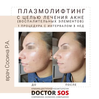 Безоперационная блефаропластика холодной плазмой - «Безоперационная  блефаропластика холодной плазмой. Возможно ли избавиться от нависания  верхнего века без операции и болезненных уколов? Фото до/после, процесс  заживления» | отзывы