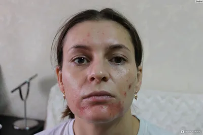 Плазмотерапия (PRP-терапия) для волос в Москве: цены, фото до и после,  отзывы | Стоимость курса плазмолифтинга для волос в клинике Seline
