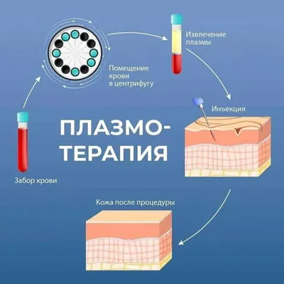 Что такое плазмолифтинг? | Блог Vita Verde