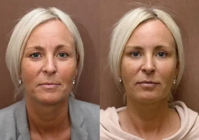Плазмолифтинг Endoret - клиника Beauty Trend в Москве