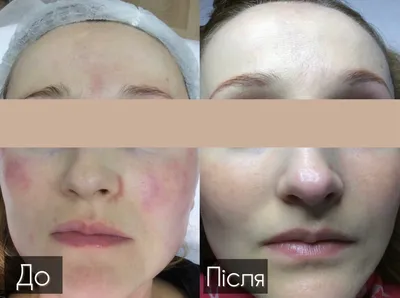 Клиника женского здоровья «МаксиМед» представляет пациентам новую  инновационную услугу: плазмолифтинг в гинекологии