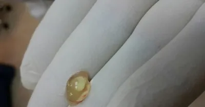 Плодное яйцо при медикаментозном аборте фото фотографии