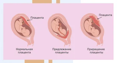 Медикаментозное прерывание беременности (фармаборт) в Жуковском и Раменском  | Клиника 9