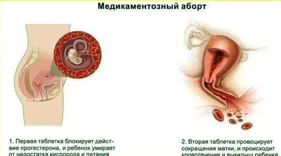 Остатки плодного яйца после медикаментозного прерывания беременности:  симптомы неполного аборта