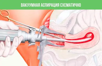 Медикаментозное прерывание беременности в Киеве