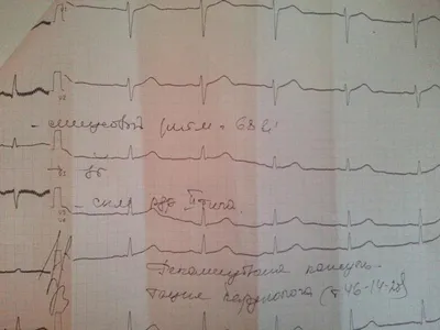 Расшифровка ЭКГ для чайников с примерами - E-Cardio