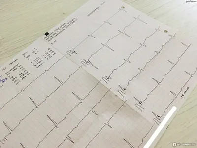 Пожалуйста, расшифруйте мои ЭКГ. | Консультация кардиолога в Минске на  DOKTORA.BY - ВРАЧИ БЕЛАРУСИ