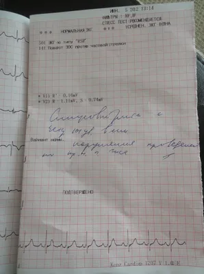Перенесла инфаркт на ногах. Случай из практики. | Кардиолог Константин  Крулёв | Дзен