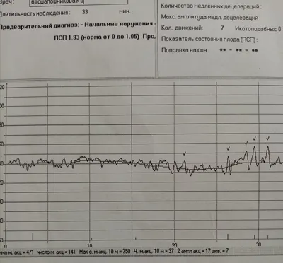 Электрокардиография (ЭКГ) - «Как оказалось не самое информативное  исследование! Мое плохое ЭКГ с детства и здоровое сердце.» | отзывы