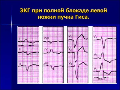 Блог по клинической электрофизиологии: Руководство по анализу артефактов на  ЭКГ