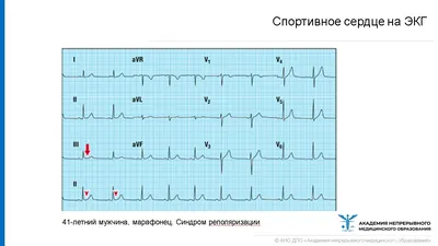 Плохая кардиограмма - Вопрос кардиологу - 03 Онлайн