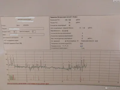 ЭКГ с нагрузкой для секции плохая, зайдите в тему Форум