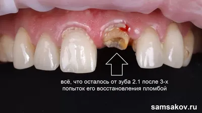 Пломба на передний зуб фото фотографии