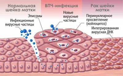 ВПЧ: что это, диагностика, лечение - Медицинский центр «ПУТЬ К ЗДОРОВЬЮ» в  Колпино