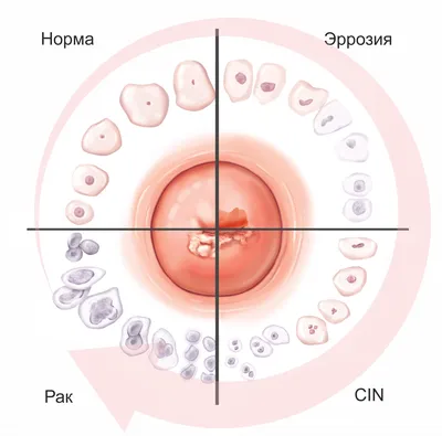 Что такое папиллома и чем она вызвана. Разновидности папиллом.