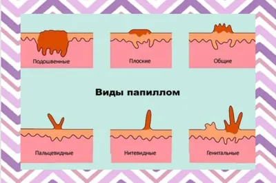 🥇 Удаление папиллом, бородавок и кондилом лазером по выгодной цене в  Алматы | MLC