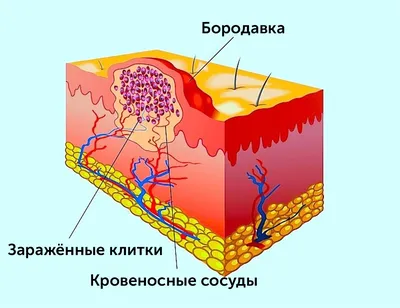 Удаление папиллом - Бушуев Семен Дмитриевич