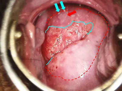 Atlas of visual inspection of the cervix with acetic acid for screening,  triage, and assessment for treatment