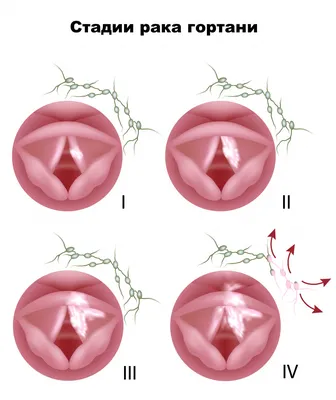 Рак гортани - причины появления, симптомы заболевания, диагностика и  способы лечения