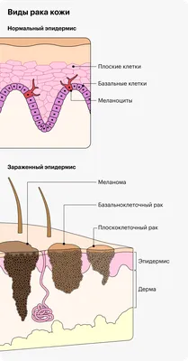 Рак кожи: симптомы, как выглядит, признаки, стадии, лечение