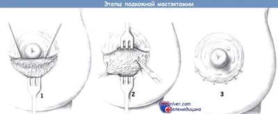 Подкожная мастэктомия слева, профилактическая мастэктомия справа с  одномоментной реконструкцией имплантом.