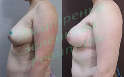 Подкожная мастэктомия с реконструкцией | Subcutaneous mastectomy with  reconstruction - YouTube