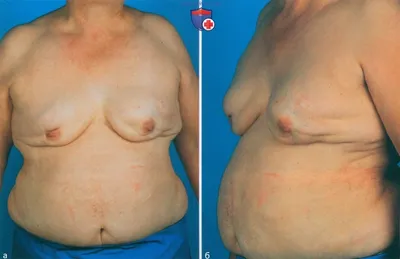 Операции на груди по поводу рака