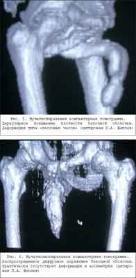 Подкожный разрыв кавернозных тел фото фотографии