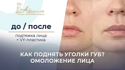 Поднять уголки рта. Ботокс — vzbeauty.ru