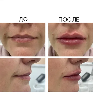 Увеличение губ: гайд года - Coolaser Clinic