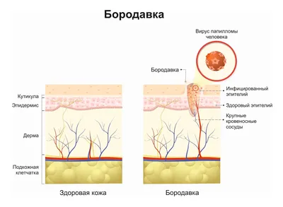 Бородавки: что это, виды, как избавиться, как выглядят, лечение и удаление