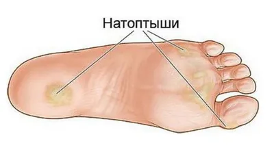 Мозоли и натоптыши на ногах. Как от них избавиться?