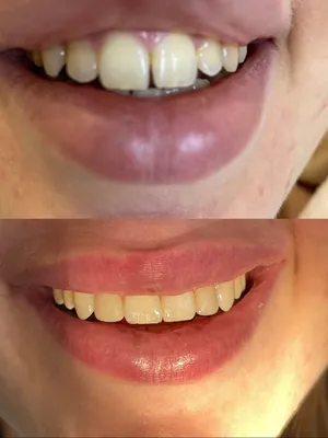 Подпиливание зубов фото до и после фотографии
