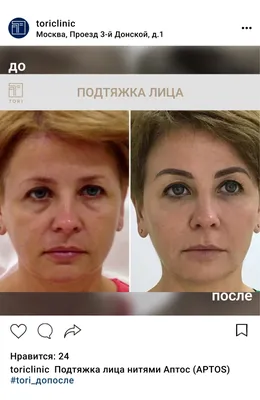 Мезонити для подтяжки лица: цены в Москве | Тредлифтинг мезонитями в  клинике BeautyWay Clinic