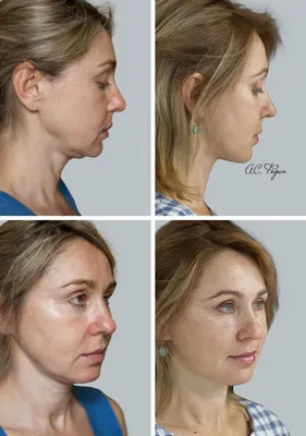 Фото до и после эндоскопической подтяжки лица