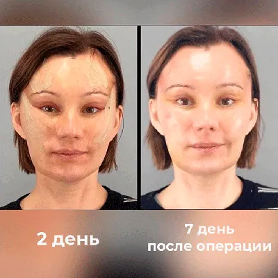 Подтяжка лица | Круговая подтяжка лица в Москве - Цены