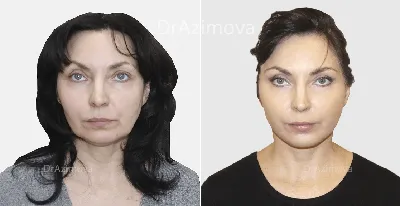 RF-лифтинг лица в Москве: цены, фото до и после, отзывы | Стоимость  RF-лифтинга лица в клинике Seline