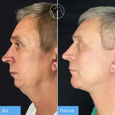 SMAS-лифтинг – фото до и после, результаты СМАС-подтяжки лица |  Пластический хирург Азимова Рано