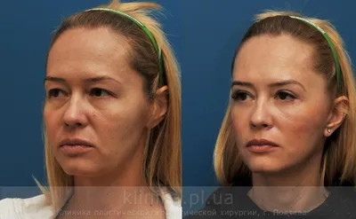 Подтяжка лица (фото до и после) – Майский И. А.