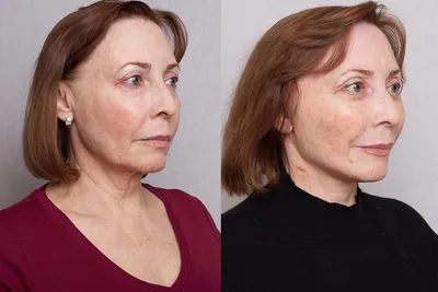 Подтяжка лица SMAS лифтинг: фото во время и после операции | Beauty Insider