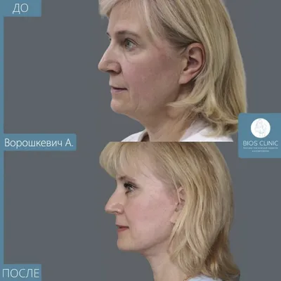 Векторный лифтинг препаратом Radiesse: цена процедуры в Москве | Инъекции  Радиесс для лица в клинике BeautyWay Clinic