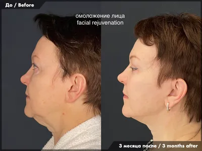 Подтяжка лица, лифтинг лица и шеи в Ярославле | Пластический хирург Эдуард  Калашян