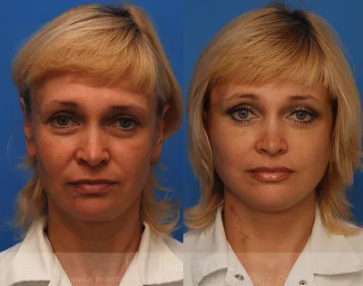 SMAS-лифтинг – фото до и после, результаты СМАС-подтяжки лица |  Пластический хирург Азимова Рано