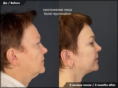 Фотогалерея подтяжка лица до и после в клинике Nove Tilo в Киеве - Nove Tilo