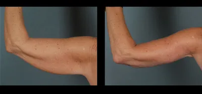 Пластика рук (брахиопластика) → Фото результатов до и после пластической  операции
