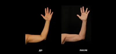 Брахиопластика (фото до и после) – Исамутдинова Г. М.