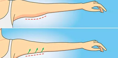 Подтяжка бедер: фотографии до и после - Nordesthetics Clinic