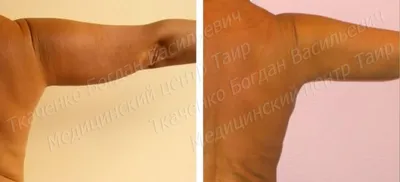 Лазерное омоложение кожи рук в Москве | Цены на омоложение лазером кистей  рук